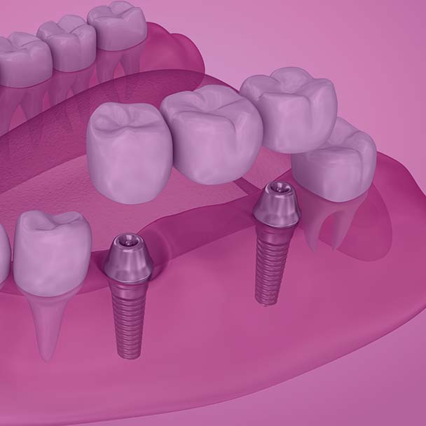 Treatment - Droitwich Spa Dental