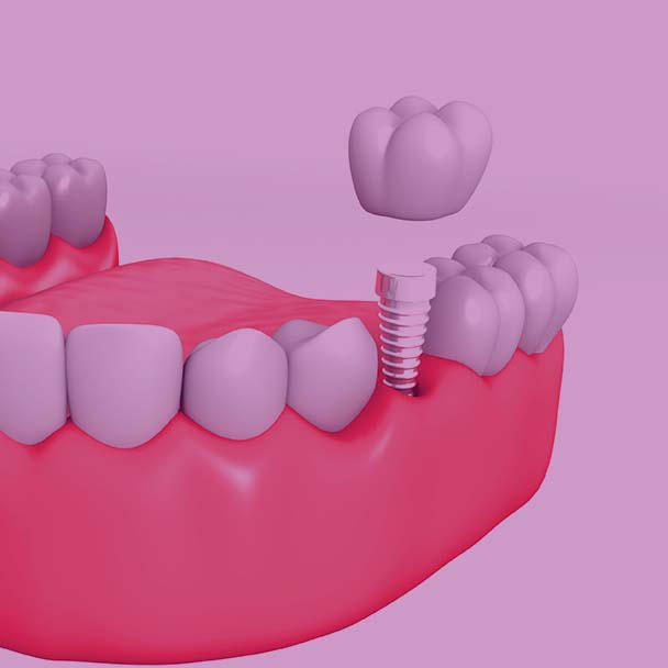 Treatment - Droitwich Spa Dental